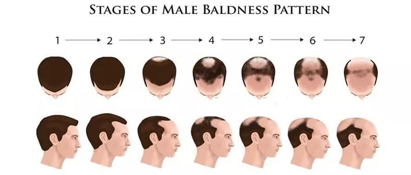 Stages of Male Baldness Pattern Stages of Male Baldness Pattern